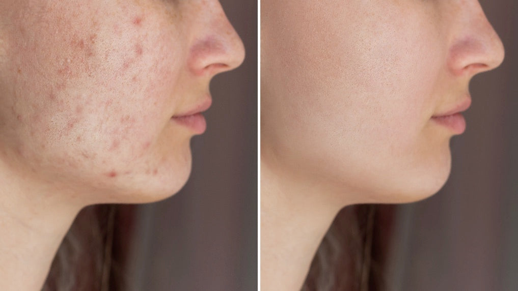 Do Sunbeds Help Acne?